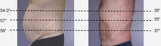 Before and After Hair Removal Photos